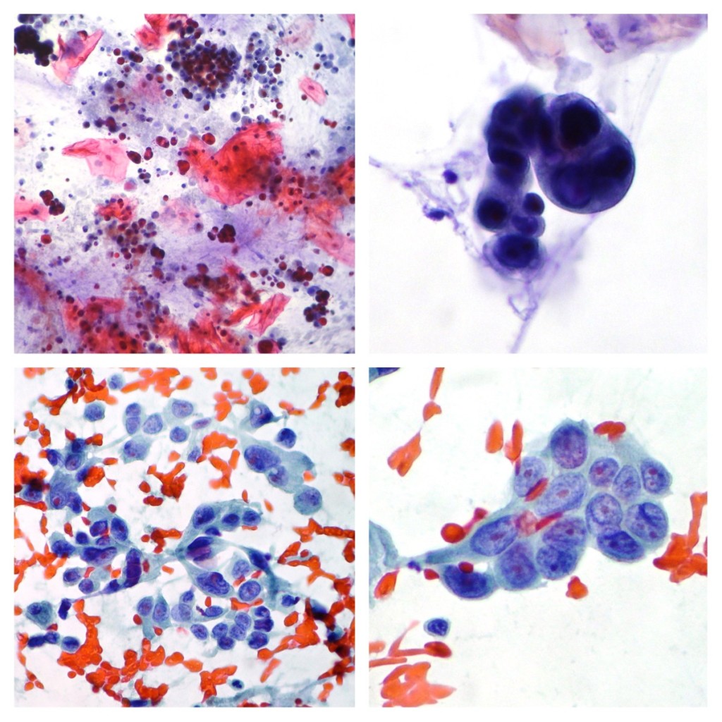 Lung Cytopathology