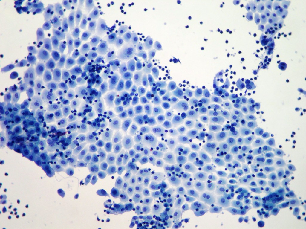 Effusions Cytopathology 4498