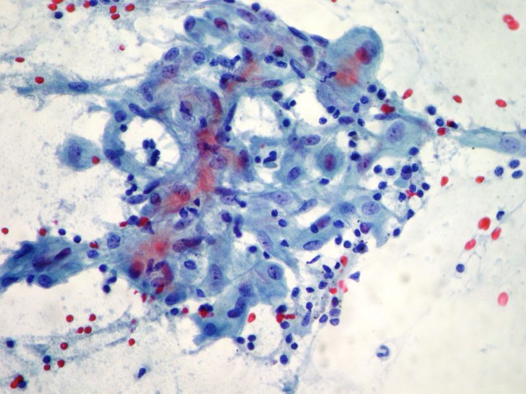 Lung Cytopathology – Cellnetpathology.com